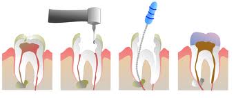 Root Canal