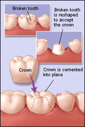 Crown